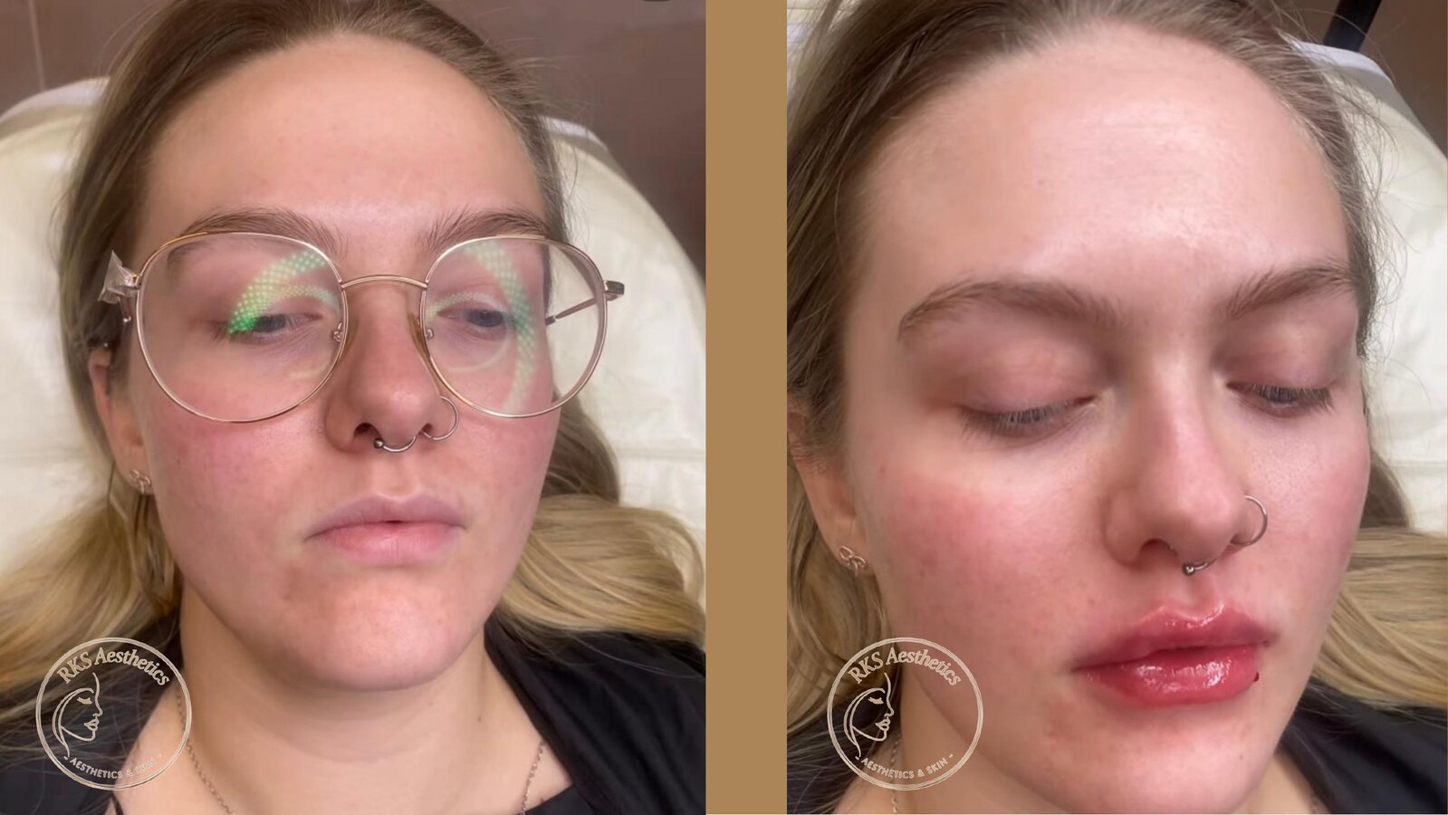 Lip Refresh — RKS Aesthetics treatment layout