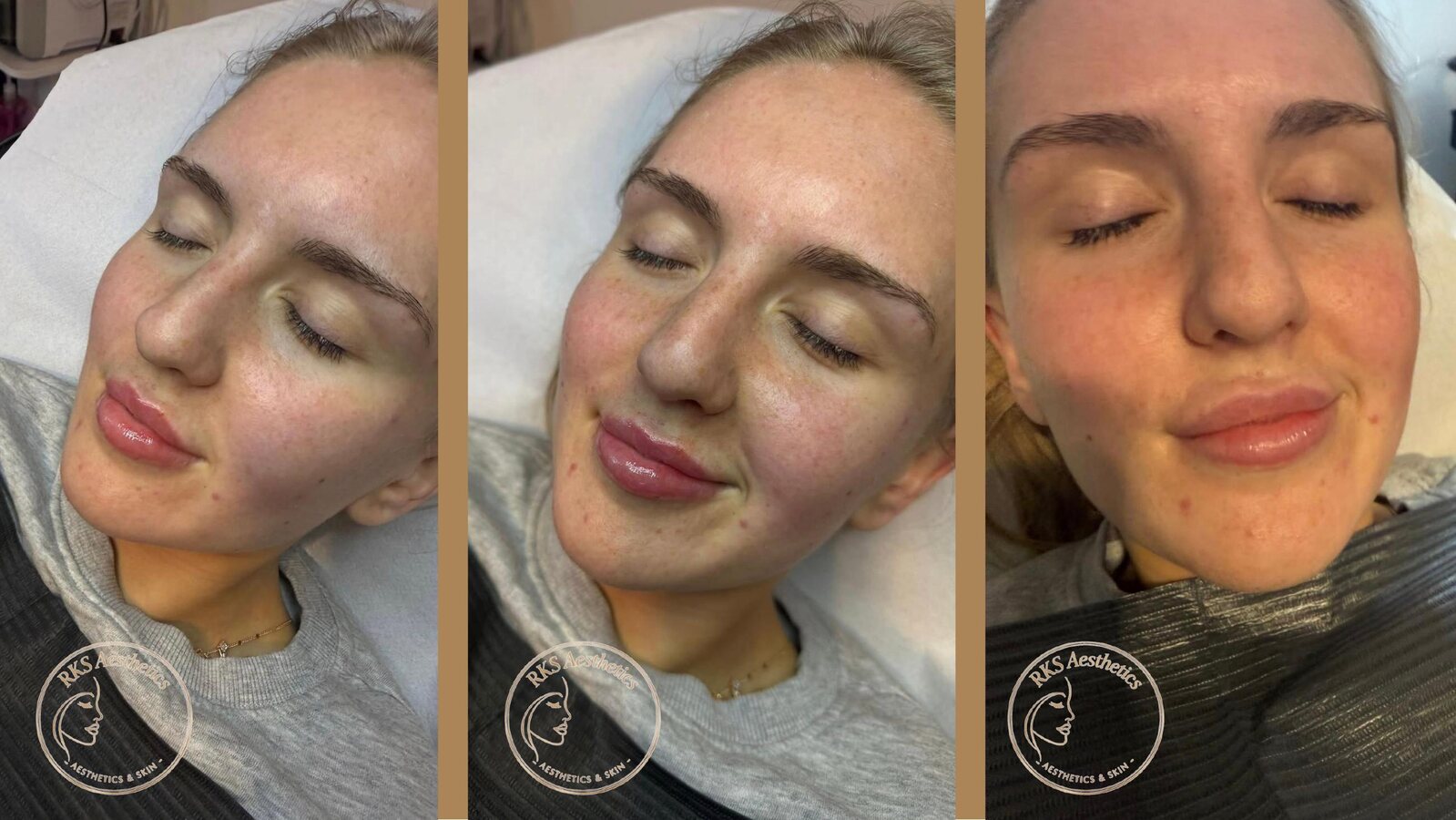 Skin Booster — RKS Aesthetics treatment layout