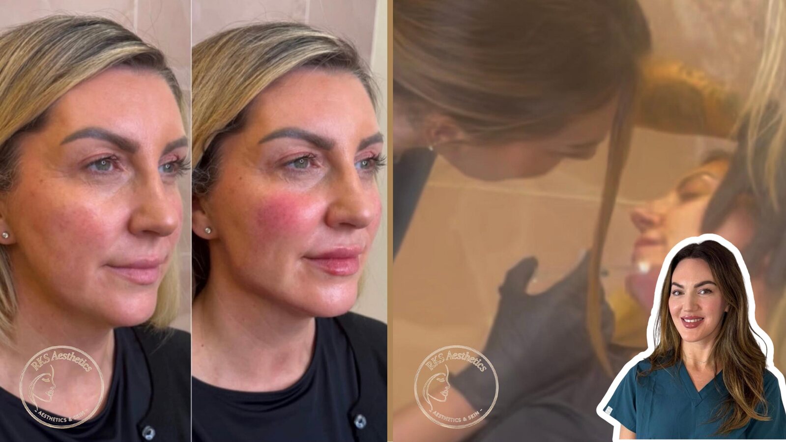 Anti-Wrinkle Smoothing — RKS Aesthetics treatment layout