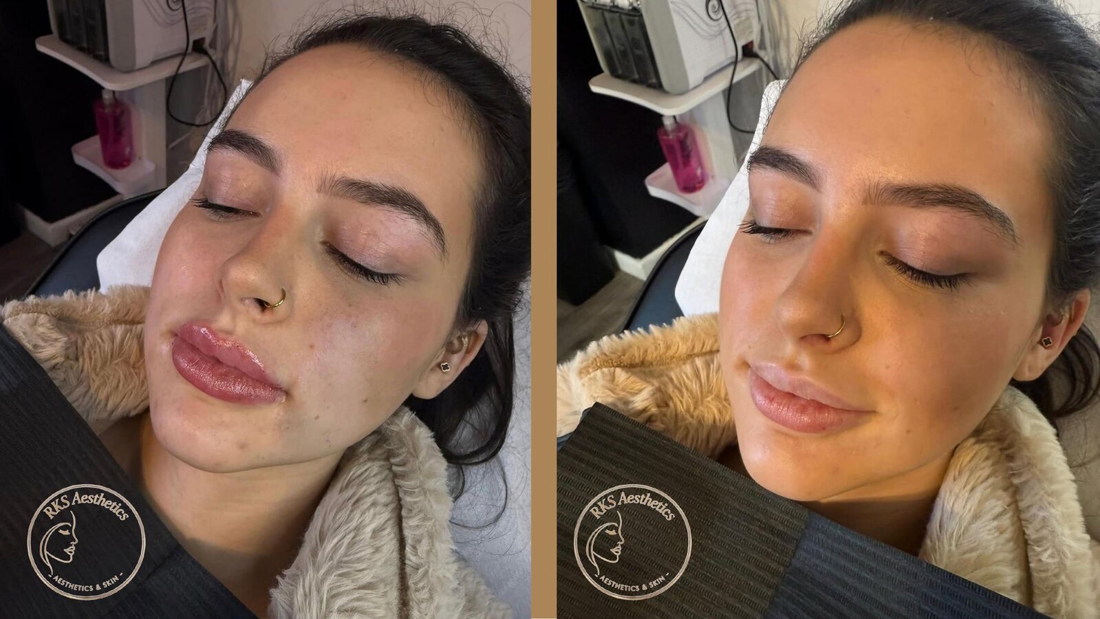 Contour & Definition — RKS Aesthetics treatment layout